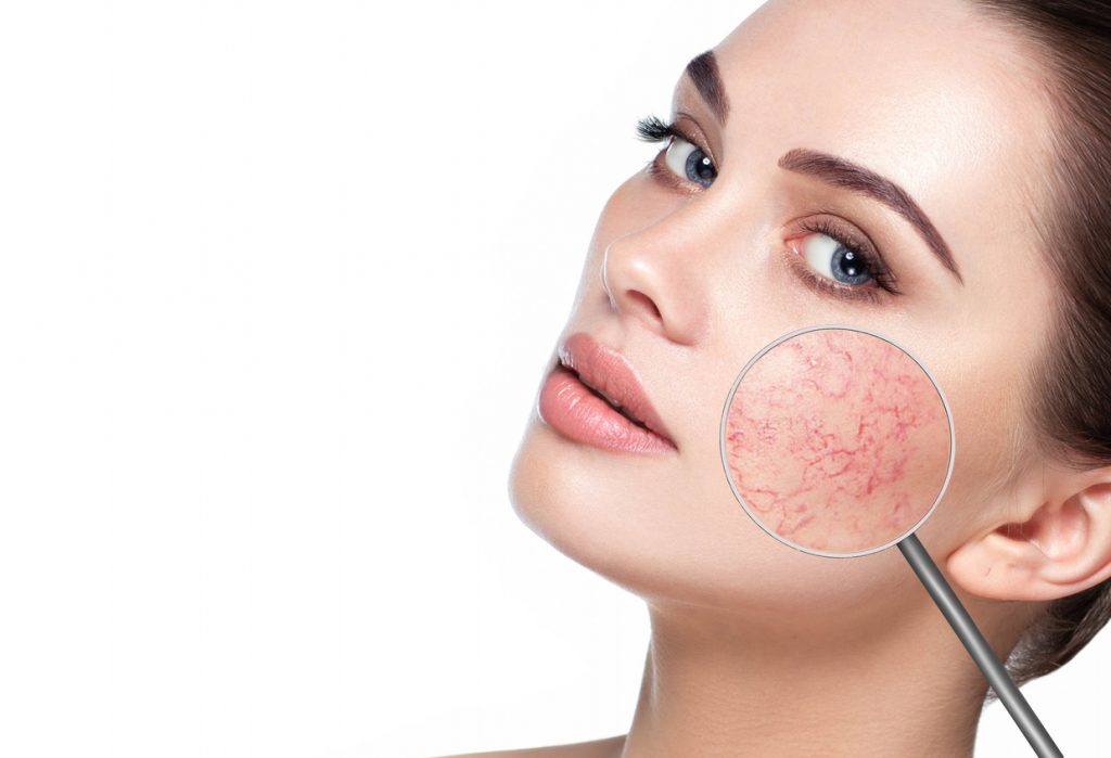 Rosacea - SkinBizz